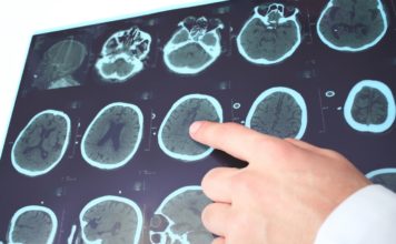 Az epilepszia tünetei epilepszia tünetei